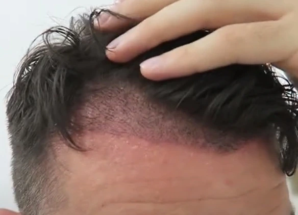 Scabs removed after washing 14 days after a hair transplant