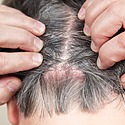 Scalp Psoriasis – Diagnosis And Treatments