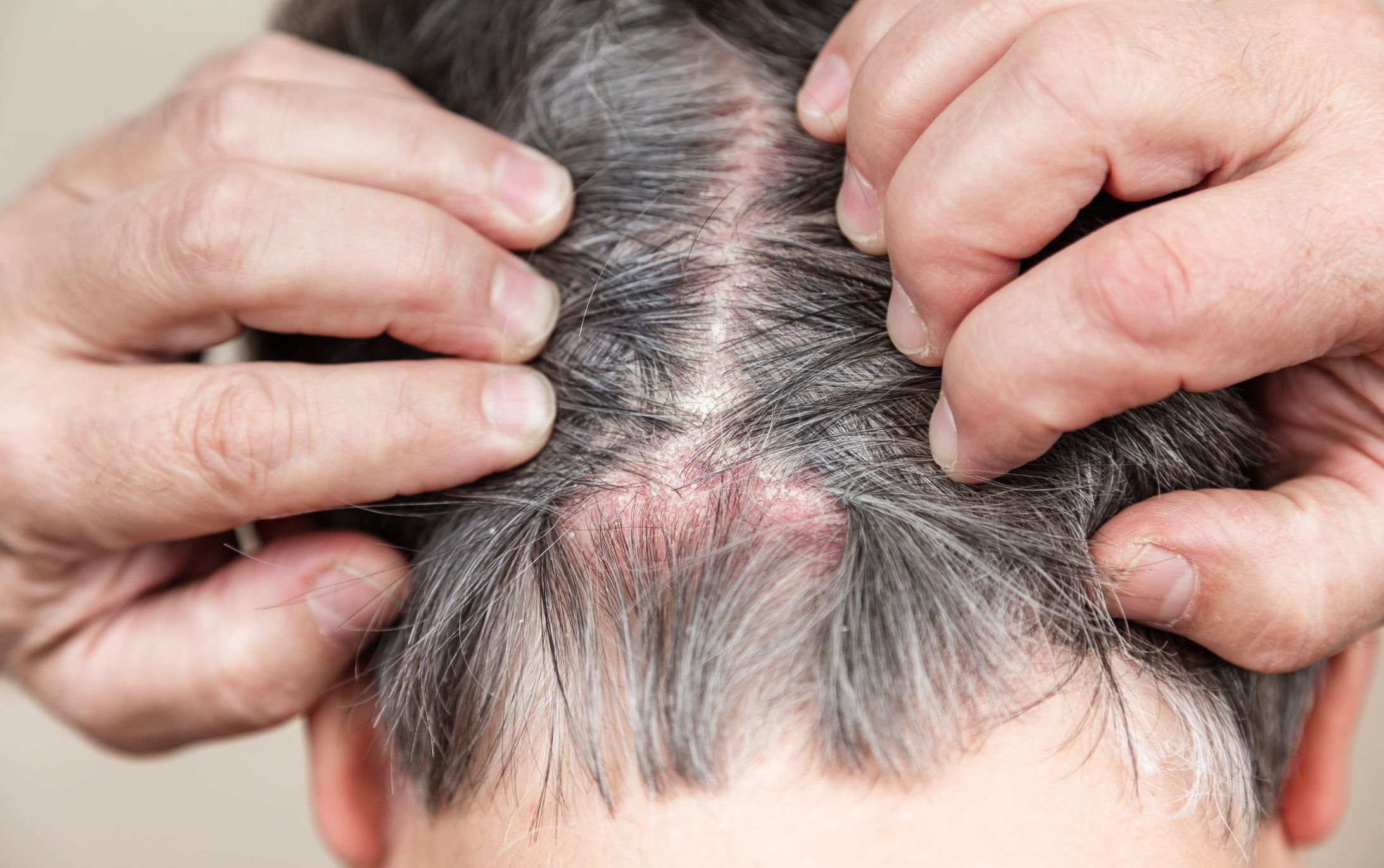 18 Causes of Hair Loss, and How to Treat It