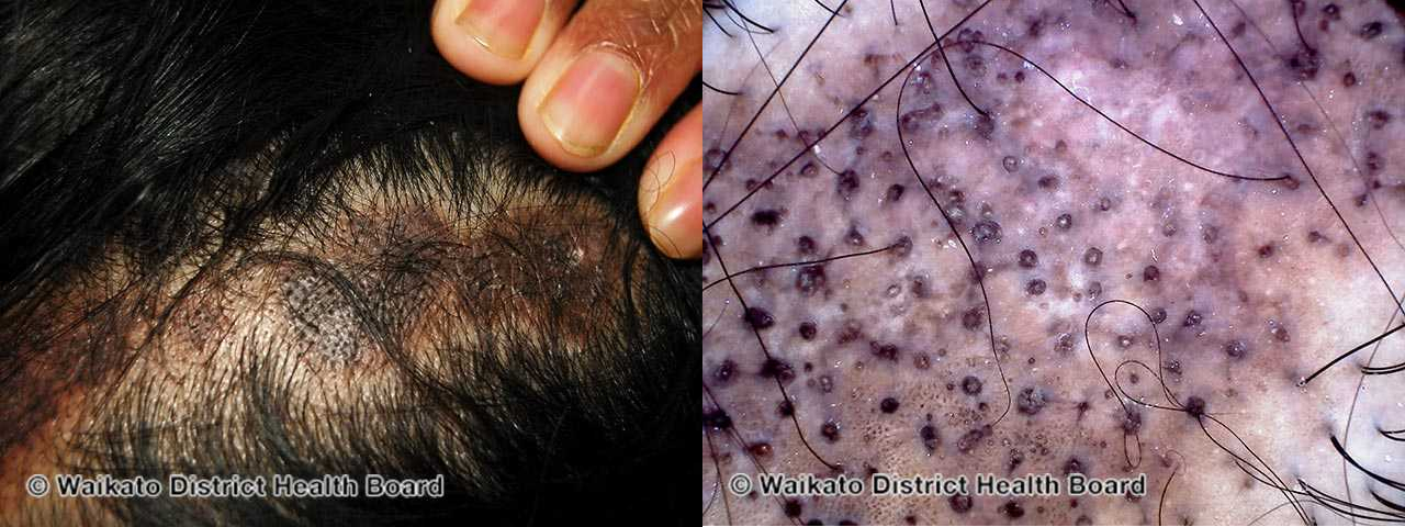 Photo showing scalp hyperpigmentation (left) and follicle plugging (right).