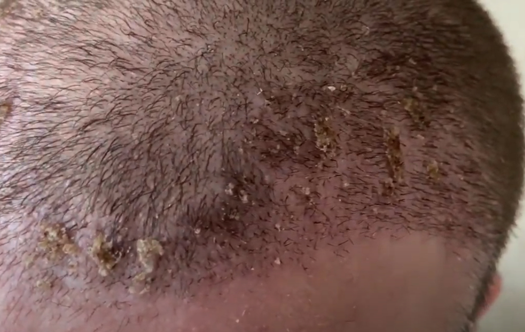 Scabs after 14 days following an FUE hair transplant