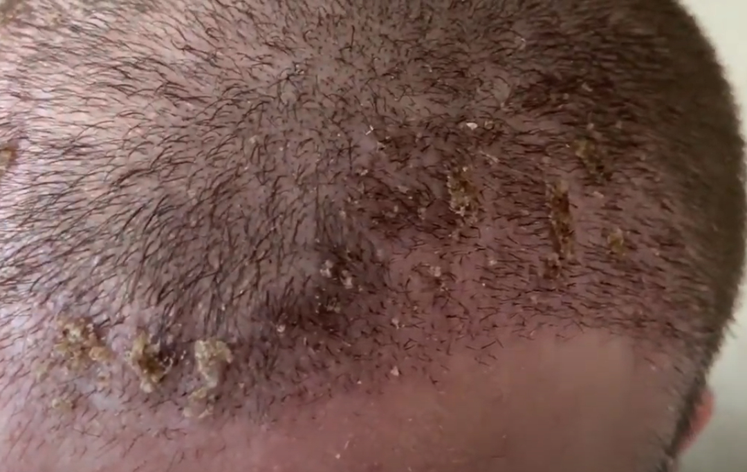 scabs on scalp 14 days after FUE hair transplant