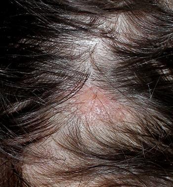 Scar tissue left on the scalp from lichen planopilaris