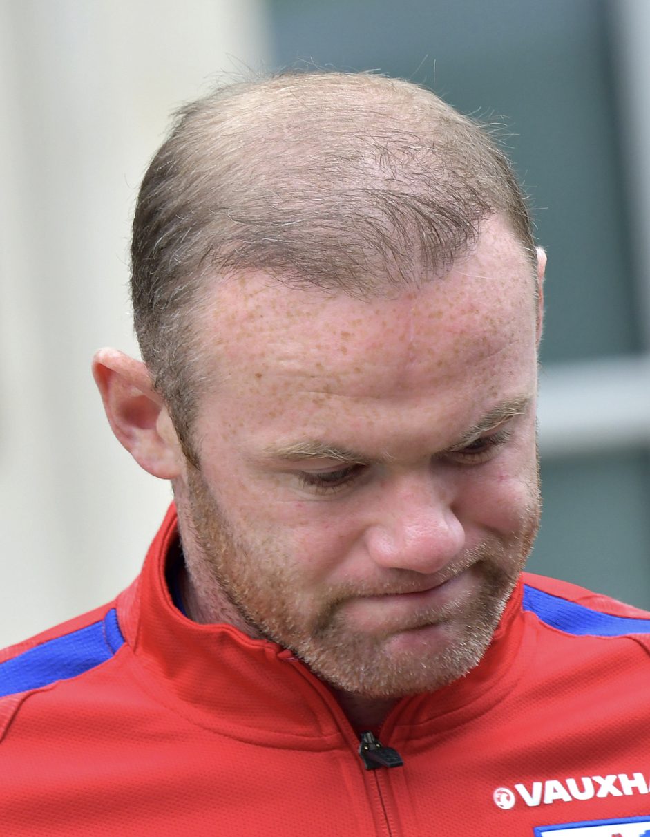 Wayne Rooney's hair showed noticeable signs of thinning 5 years after his first hair transplant.