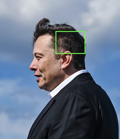 Hair transplant scars on Elon Musk