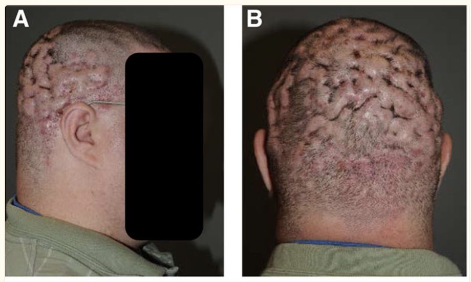 A patient with cysts on the head caused by dissecting cellulitis.