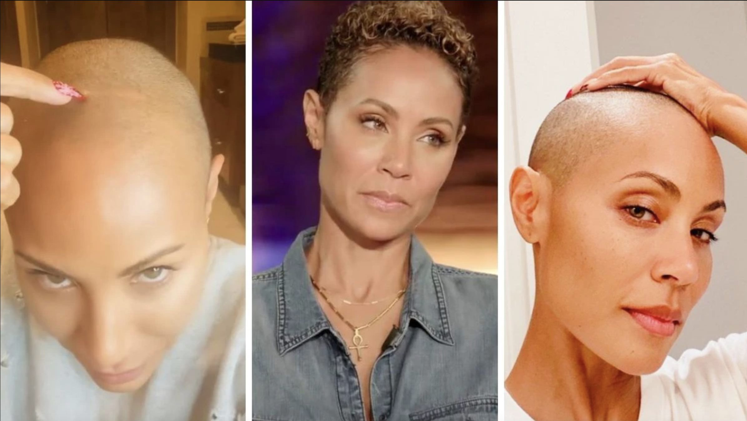 12 Celebrities With Alopecia & Hair Loss | Wimpole Clinic