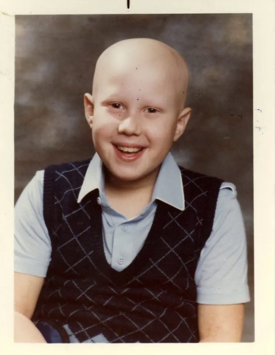 matt lucas childhood alopecia