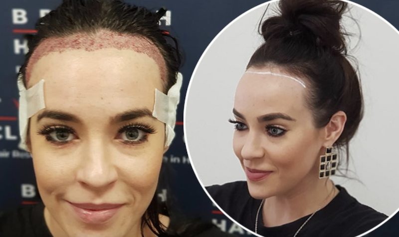 Stephanie Davis hair transplant