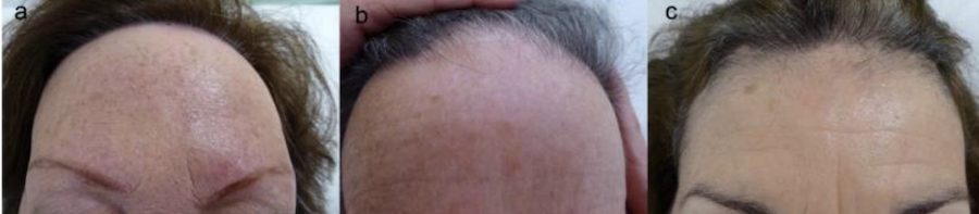 frontal fibrosing alopecia - 3 patients with progressive scarring alopecia leading to temple hair loss