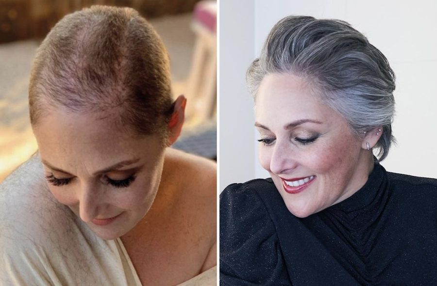 Things You Should Know About Female Hair Loss