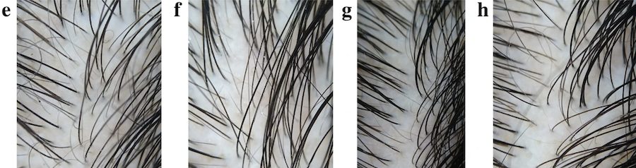 trichoscopic view of hair density before and after minoxidil treatment