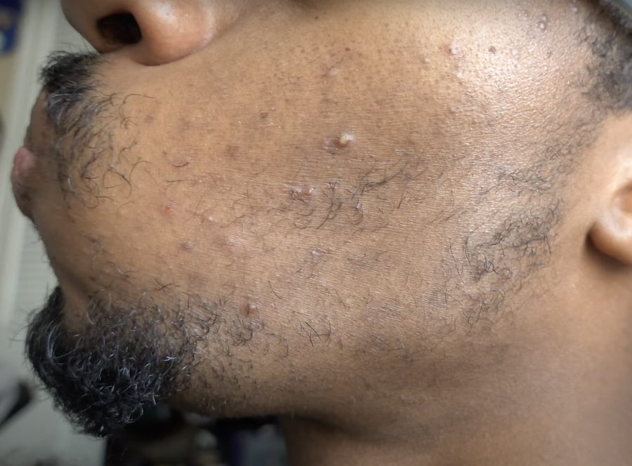 before minoxidil use for beard growth