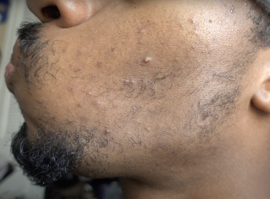 beard growth before Minoxidil