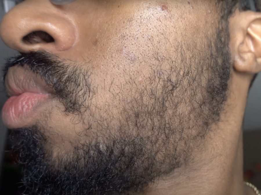 Minoxidil beard results after 3 months