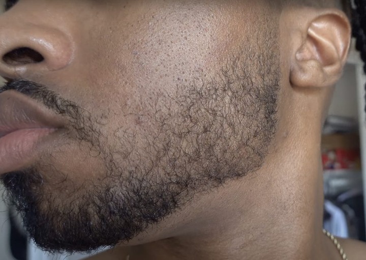 Minoxidil Beard Growth Before And After Wimpole Clinic