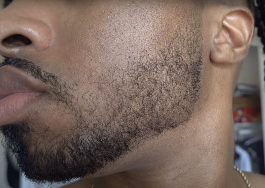 beard growth 6 months after Minoxidil treatment
