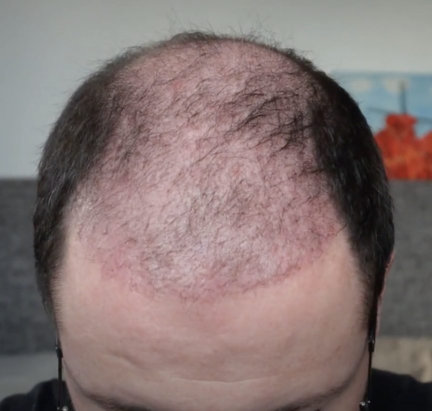 patient 2 months after hair transplant