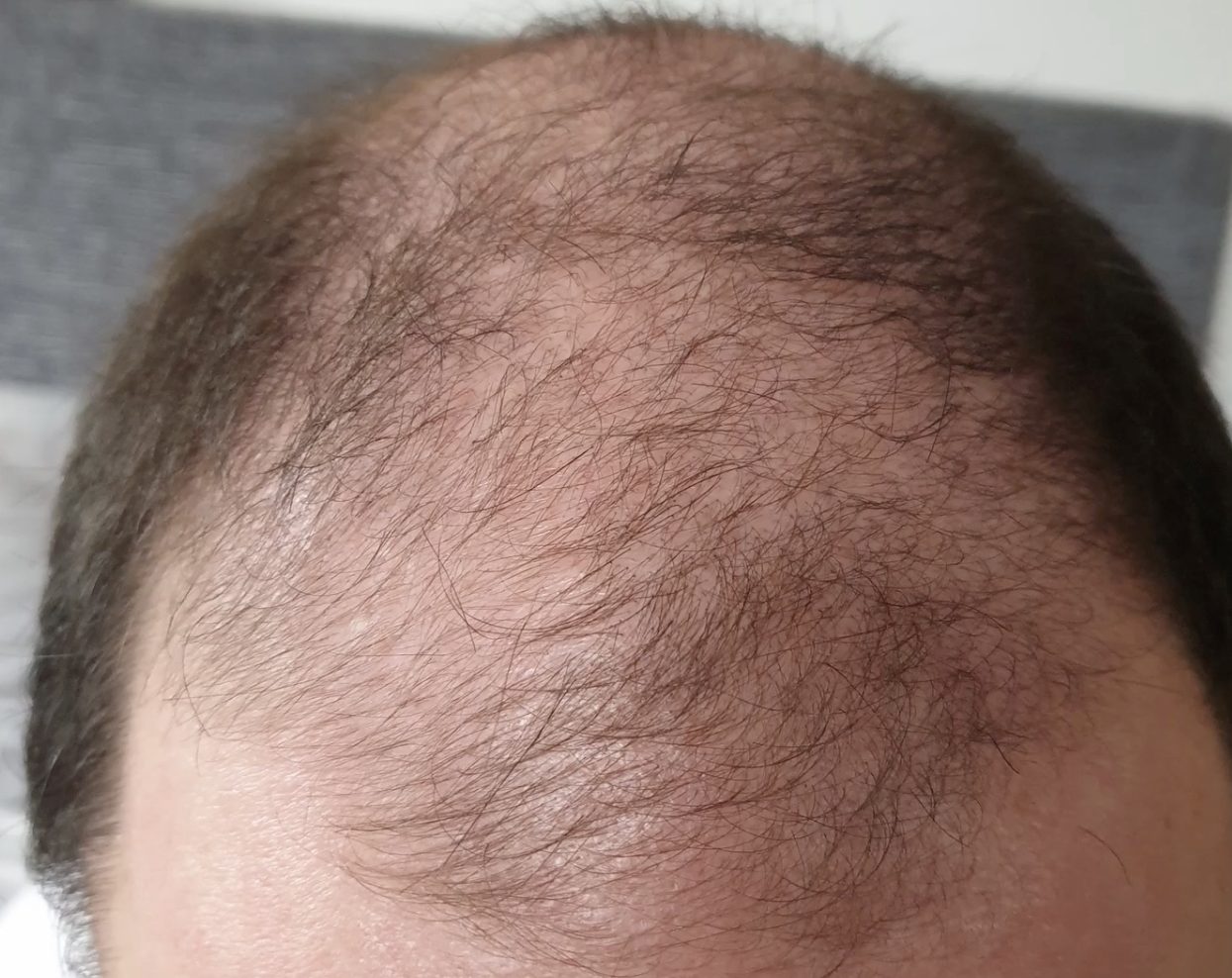 patient before hair transplant
