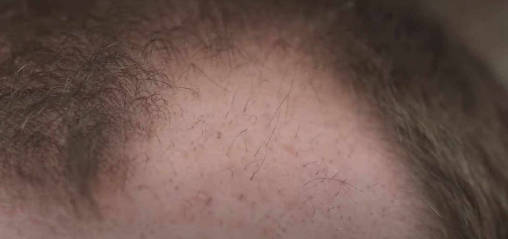 close up on graft site 2 months post hair transplant
