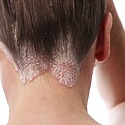 Does Seborrheic Dermatitis Cause Hair Loss?