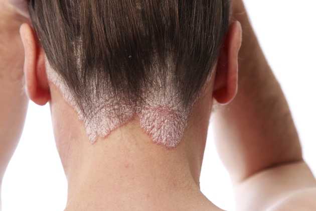 Does Seborrheic Dermatitis Cause Hair Loss? - Blog - Wimpole