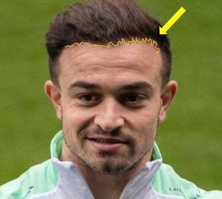 Shaqiri's uneven hairline post hair transplant