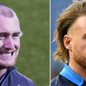 Stuart Hogg’s Hair Transplant: Everything You Need To Know