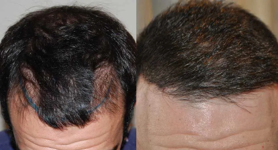 700 graft FUE temple hair transplant before and after