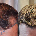 Getting A Temple Hair Transplant For Temple Hair Loss