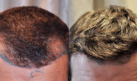 Temple Hair Transplant Featured Image