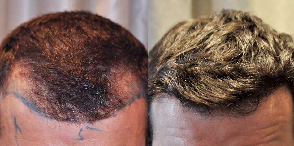 Wimpole patient before and after 1200 grafts hair transplant