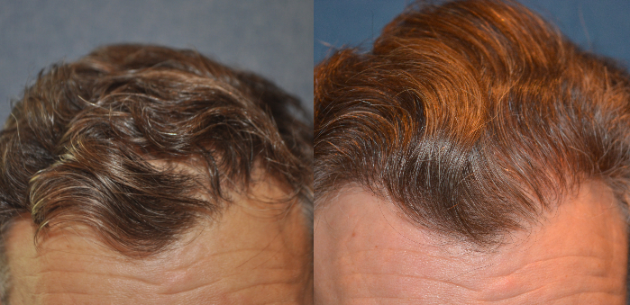 Before and after temple hair transplant with wavy hair