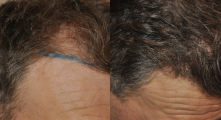 Patient before and after 500 grafts hair transplant