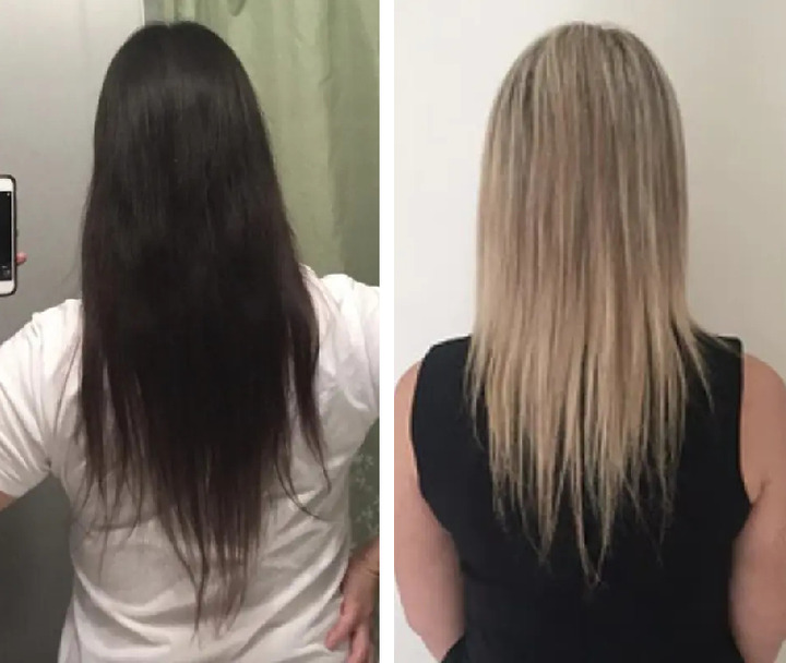 Can A Hair Transplant Treat Thinning Hair? Wimpole Clinic