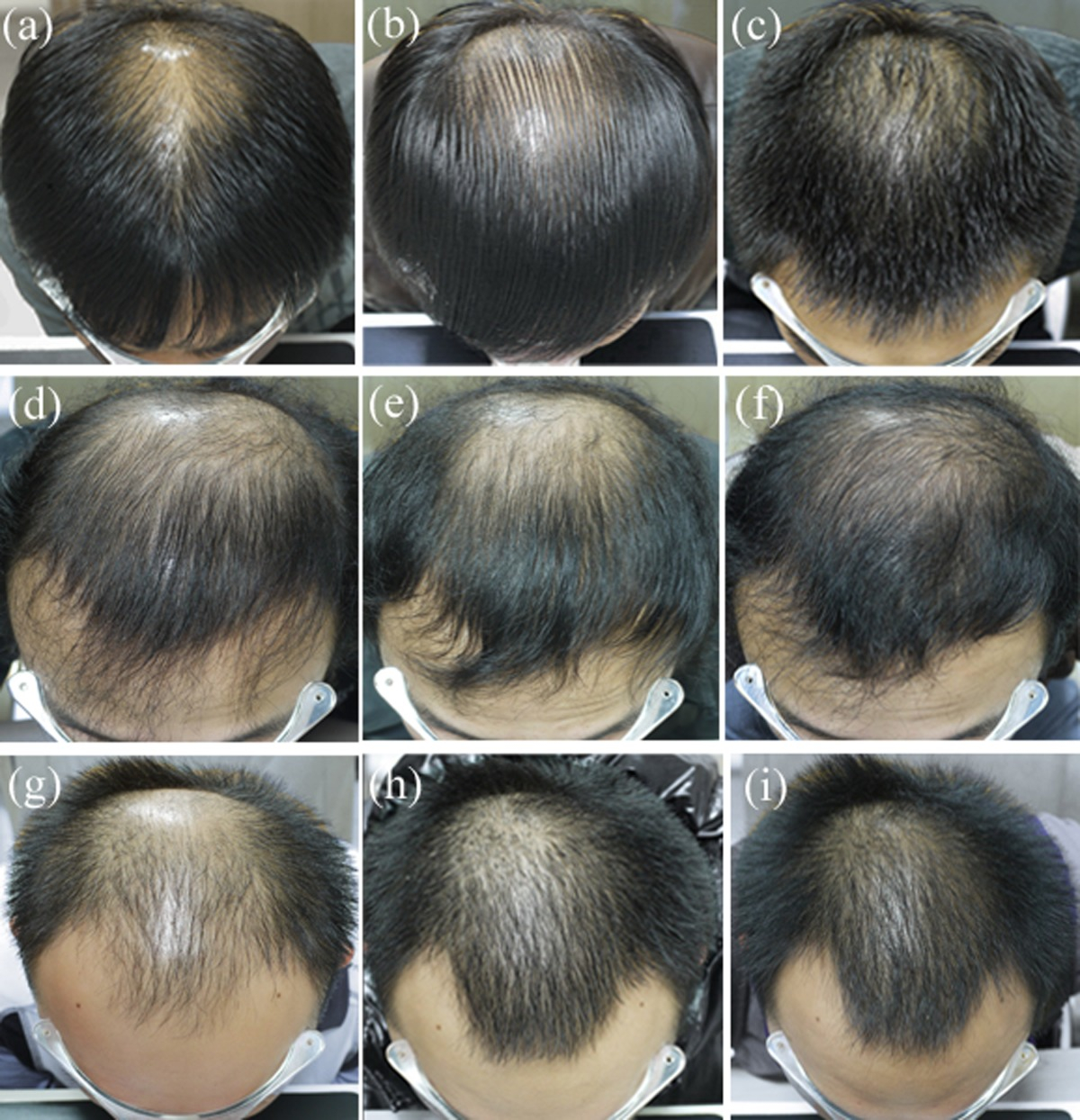 3 patients after 6 and 12 months of finasteride treatment