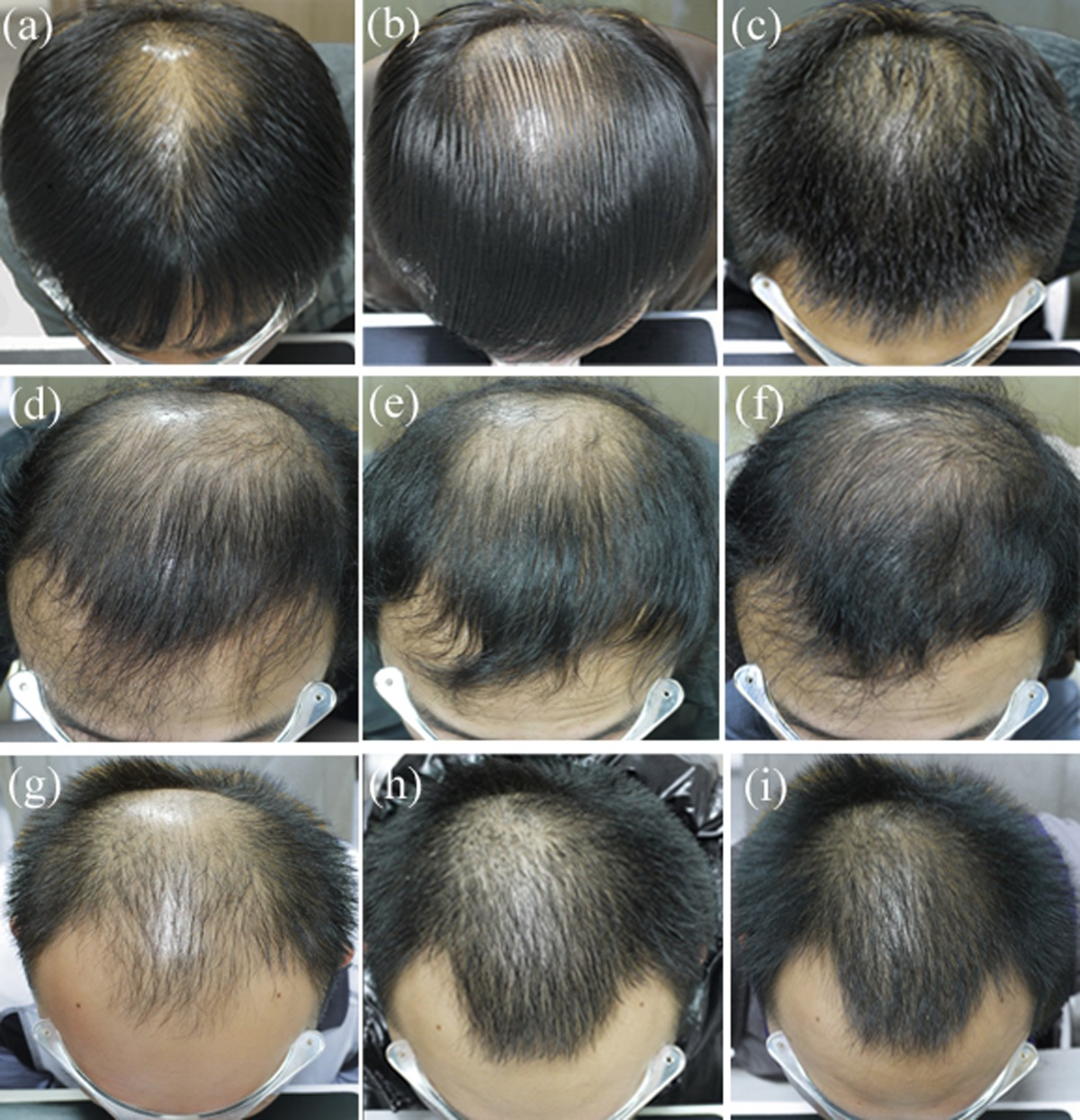 3 patients with male pattern hair loss after 6 and 12 months of finasteride treatment for hair loss