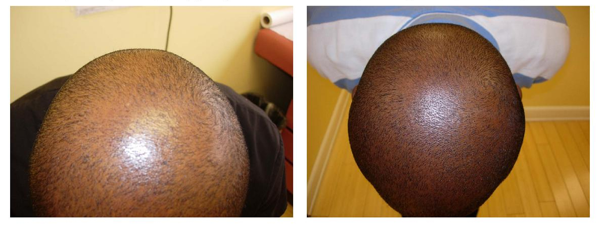 Results of topical dutasteride, topical finasteride and Minoxidil