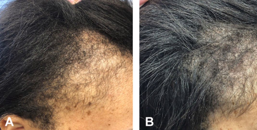 Traction Alopecia: When Is It Too Late?, Wimpole Clinic