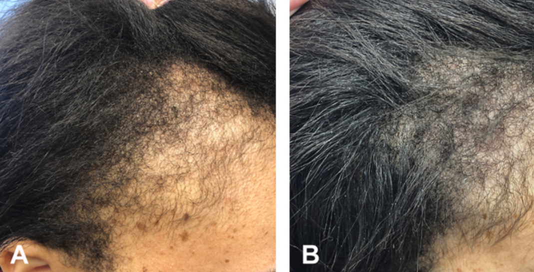 Traction alopecia before and after treatment