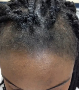 Example of Traction alopecia