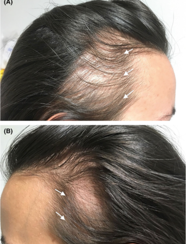 Patient with traction alopecia as a result of wearing a tight ponytail