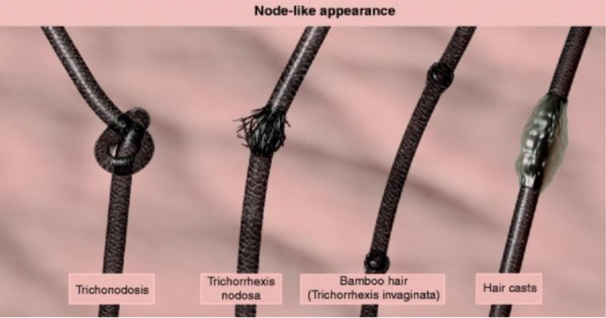 up-close photo of hair strands and the nodes that appear on them