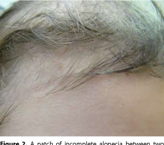 Trichotillomania at the hairline