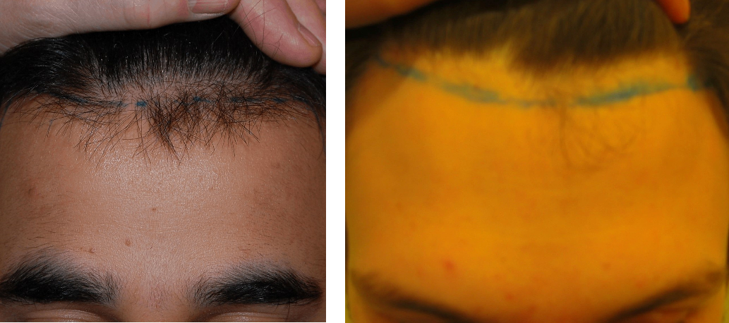 Two patients with hair loss in their mid 20s.