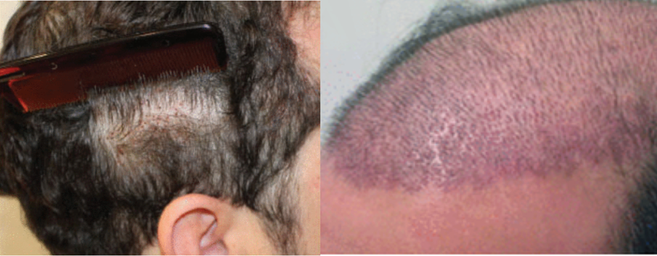 UFUE after 7 days versus a normal hair transplant after 12 days