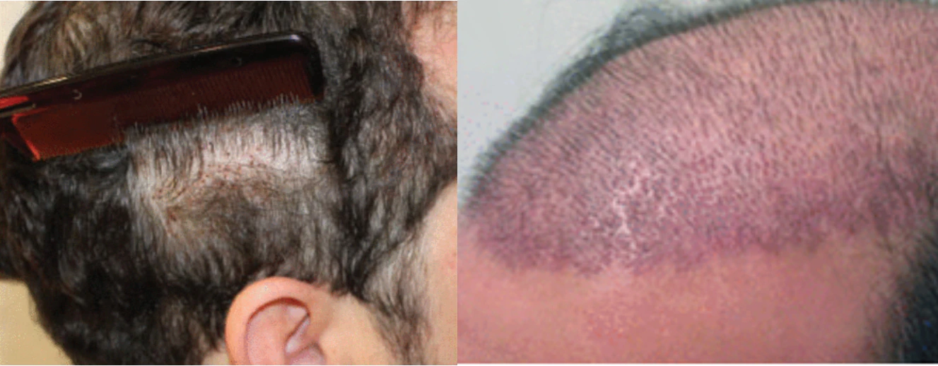 Long hair transplant seven days after the procedure (left), traditional transplant 12 days after the procedure (right)