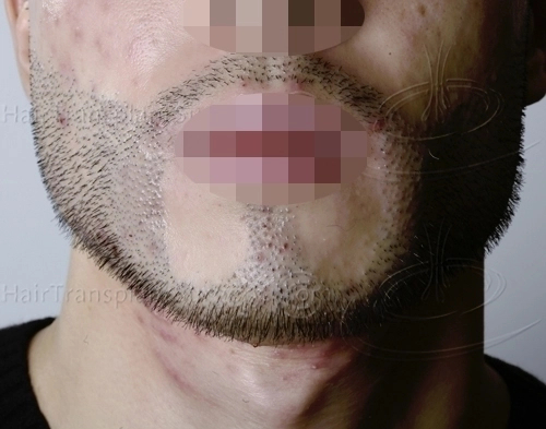 facial hair transplant failure