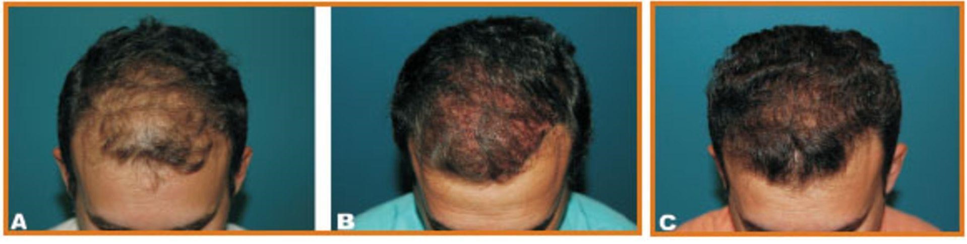 long hair transplant before procedure (A), immediately after (B), and hair growth results 6 months after procedure (C)