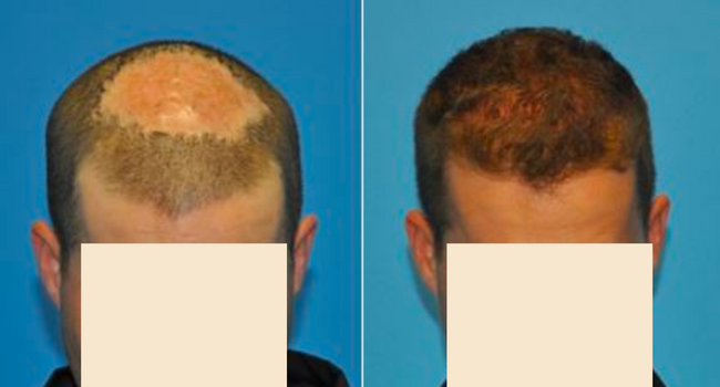 hair transplant into scars: male patient with mrsa scarring pre and post hair transplant